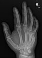 Acute 4th metacarpal and old 5th metacarpal fractures (Radiopaedia 79570-92752 Oblique 1).jpg