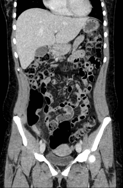 File:Acute appendicitis (Radiopaedia 22892-22918 Coronal C+ portal venous phase 16).png