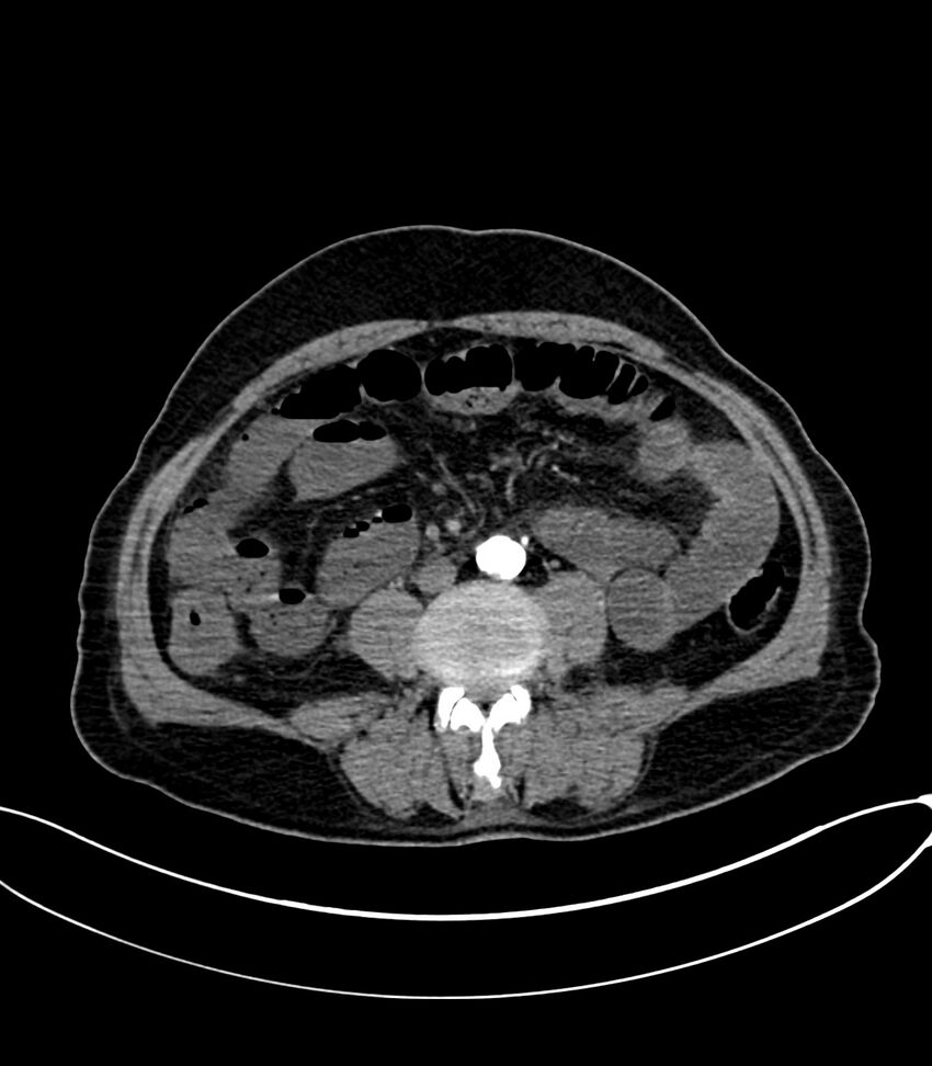 Acute arterial mesenteric ischemia (Radiopaedia 78238-90828 Axial C+ arterial phase 78).jpg