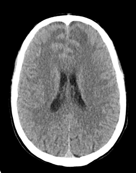 File:Acute disseminated encephalomyelitis (ADEM) (Radiopaedia 65319-74348 Axial non-contrast 20).png