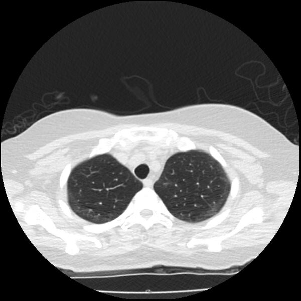 File:Acute interstitial pneumonitis (Radiopaedia 45404-49444 Axial lung window 18).jpg
