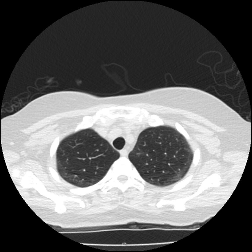 Acute interstitial pneumonitis (Radiopaedia 45404-49444 Axial lung window 18).jpg