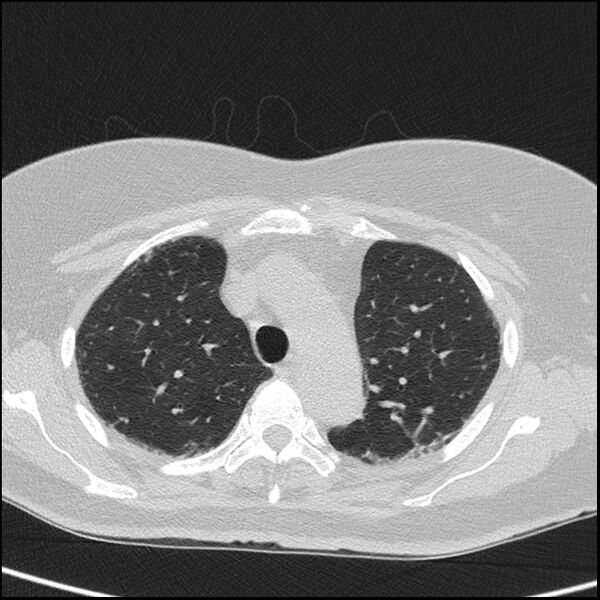 File:Acute interstitial pneumonitis (Radiopaedia 45404-49453 Axial lung window 24).jpg
