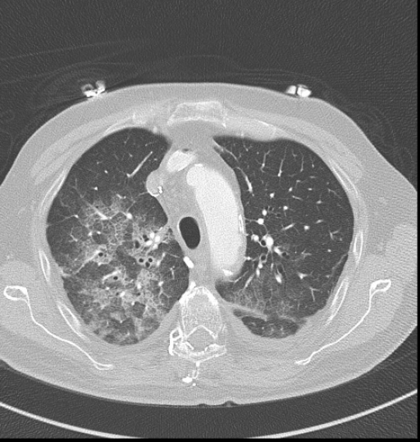 Acute myocardial infarction (Radiopaedia 23413-23481 lung window 6).jpg