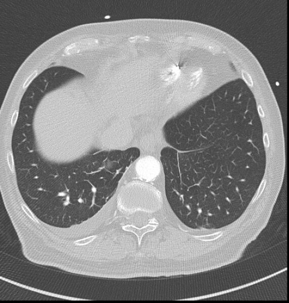 File:Acute myocardial infarction (Radiopaedia 23413-23481 lung window 60).jpg
