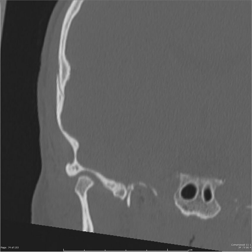 Acute otomastoiditis (Radiopaedia 28276-28512 Coronal PTB bone window reformat 5).jpg