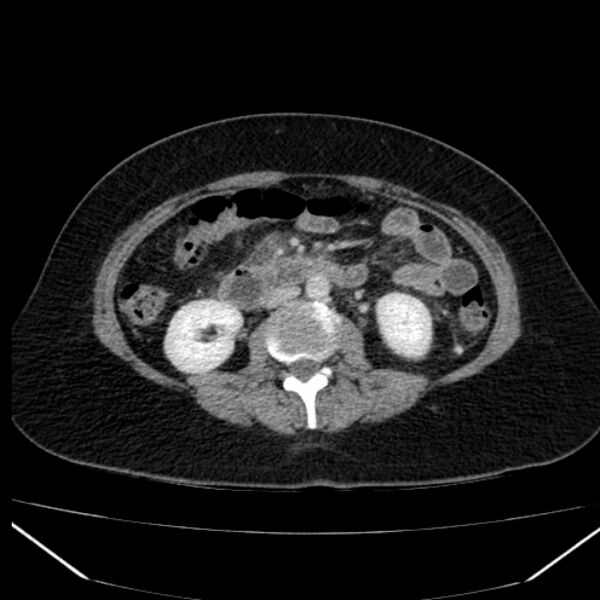 File:Acute pancreatitis - Balthazar C (Radiopaedia 26569-26714 Axial C+ portal venous phase 50).jpg