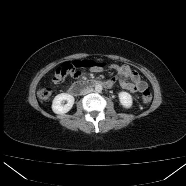 File:Acute pancreatitis - Balthazar C (Radiopaedia 26569-26714 Axial C+ portal venous phase 51).jpg