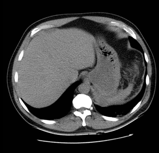 File:Acute pancreatitis - Balthazar E (Radiopaedia 23080-23110 Axial non-contrast 12).jpg
