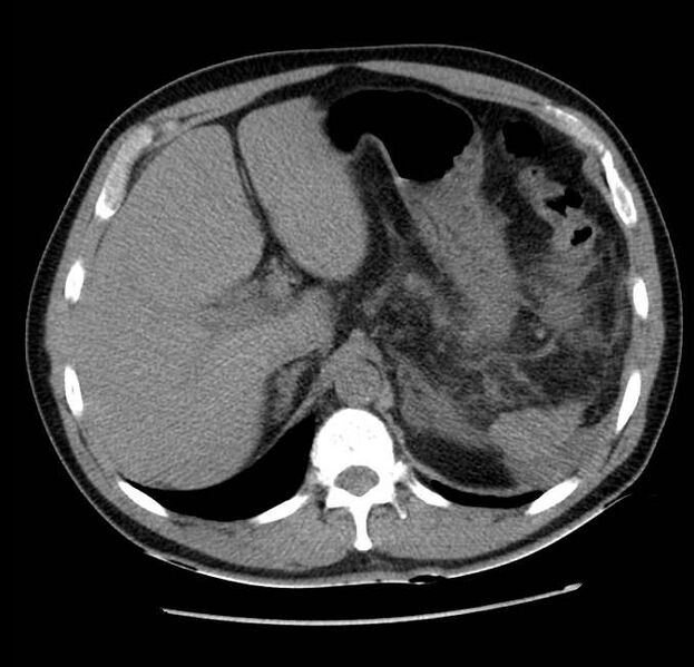File:Acute pancreatitis - Balthazar E (Radiopaedia 23080-23110 Axial non-contrast 17).jpg
