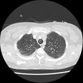 Acute pulmonary edema on CT (Radiopaedia 33582-34672 Axial lung window 9).jpg