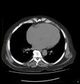 Acute renal failure post IV contrast injection- CT findings (Radiopaedia 47815-52559 Axial C+ portal venous phase 1).jpg
