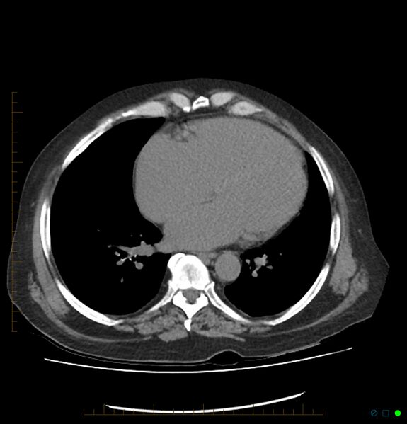 File:Acute renal failure post IV contrast injection- CT findings (Radiopaedia 47815-52559 Axial C+ portal venous phase 1).jpg