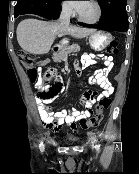 File:Acute renal infarction - rim capsular enhancement (Radiopaedia 59833-67270 Coronal C+ portal venous phase 11).jpg