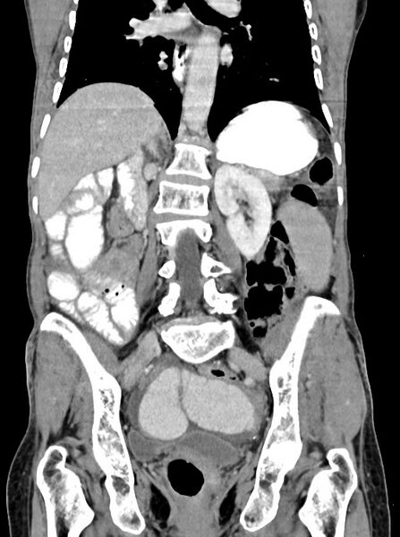 File:Acute small bowel (ileal) volvulus (Radiopaedia 71740-82139 Coronal C+ portal venous phase 72).jpg
