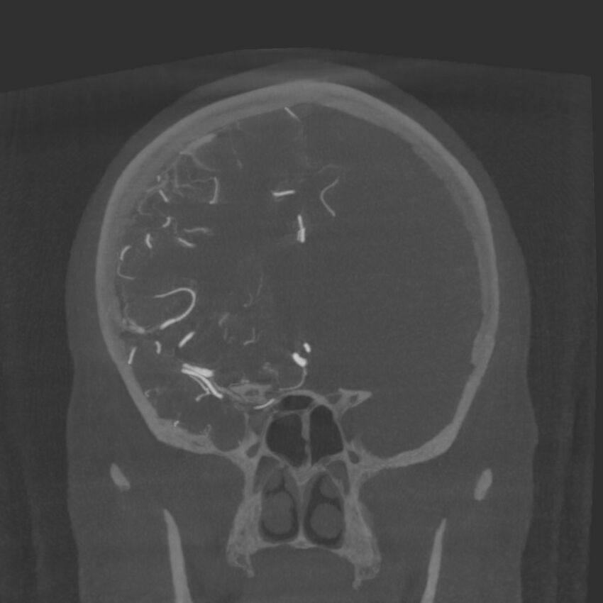 Acute subarachnoid hemorrhage and accessory anterior cerebral artery (Radiopaedia 69231-79010 Coronal arterial - MIP 37).jpg