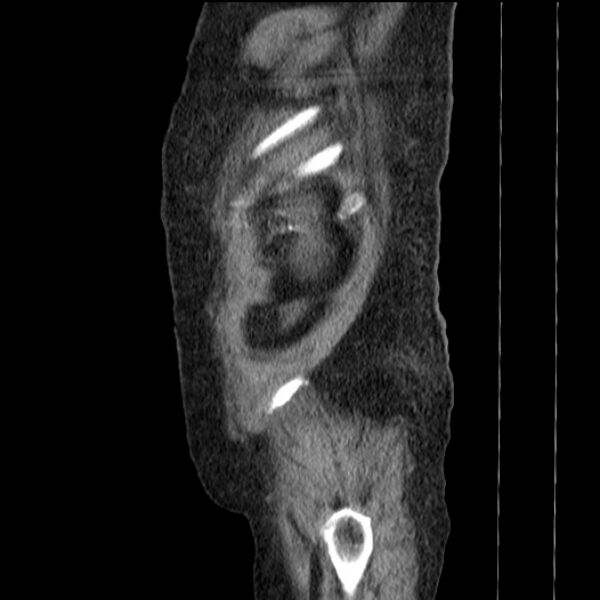 File:Acute tubular necrosis (Radiopaedia 28077-28334 Sagittal non-contrast 79).jpg