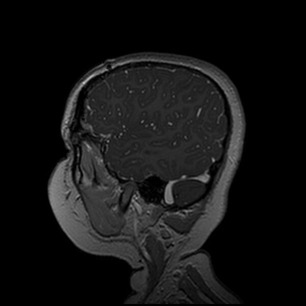 File:Adamantinomatous craniopharyngioma (Radiopaedia 77407-89529 H 99).jpg
