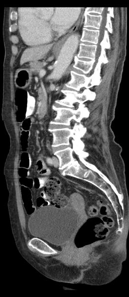 File:Adenocarcinoma of cecum (Radiopaedia 59222-66549 Sagittal C+ portal venous phase 40).jpg