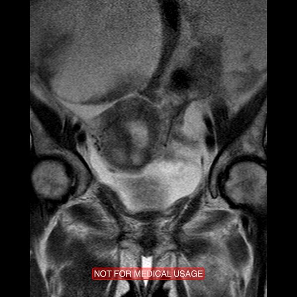 File:Adenocarcinoma of the cervix (Radiopaedia 28373-28615 Coronal T2 7).jpg