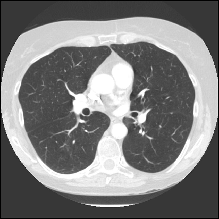 Adenocarcinoma of the lung (Radiopaedia 41015-43755 Axial lung window 60).jpg