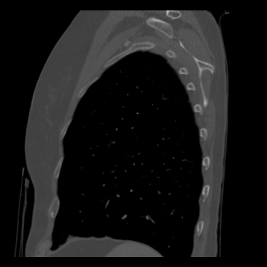 Adenocarcinoma of the lung (Radiopaedia 41015-43755 Sagittal bone window 91).jpg