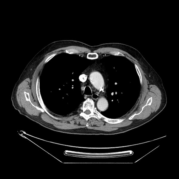 File:Adenocarcinoma of the lung (Radiopaedia 44876-48759 Axial C+ portal venous phase 29).jpg