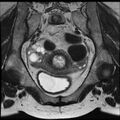 Adenoma malignum of the cervix (Radiopaedia 24460-24765 Coronal T2 10).jpg