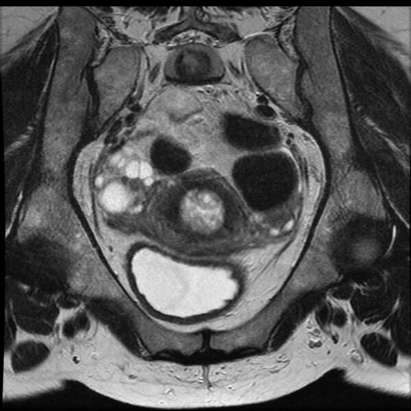 File:Adenoma malignum of the cervix (Radiopaedia 24460-24765 Coronal T2 10).jpg