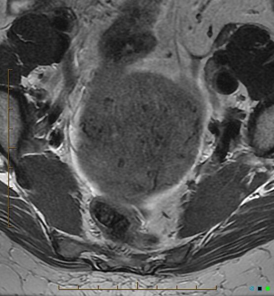 File:Adenomyosis uterus with hematometra (Radiopaedia 45779-50011 Axial T2 7).jpg