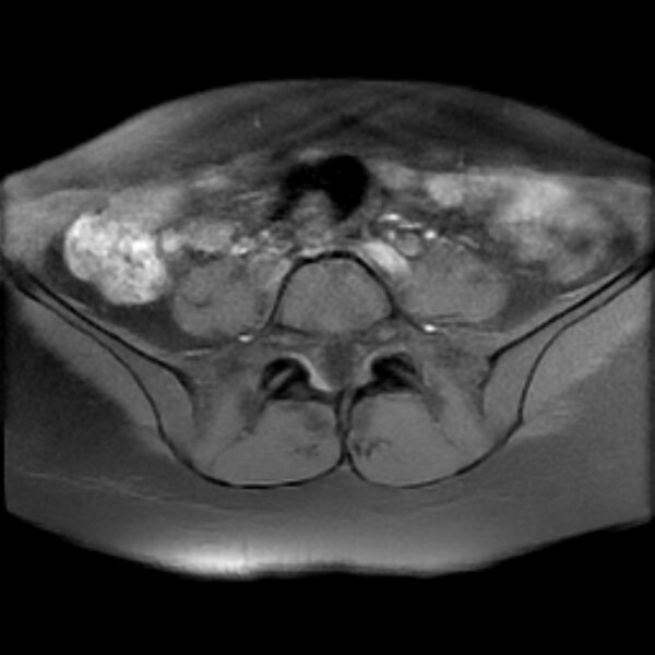 File:Adenomyosis within a septate uterus (Radiopaedia 69963-79981 Axial T1 fat sat 3).jpg