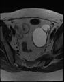 Adnexal multilocular cyst (O-RADS US 3- O-RADS MRI 3) (Radiopaedia 87426-103754 Axial T2 11).jpg