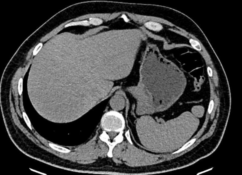 File:Adrenal metastases (Radiopaedia 73082-83791 Axial non-contrast 29).jpg