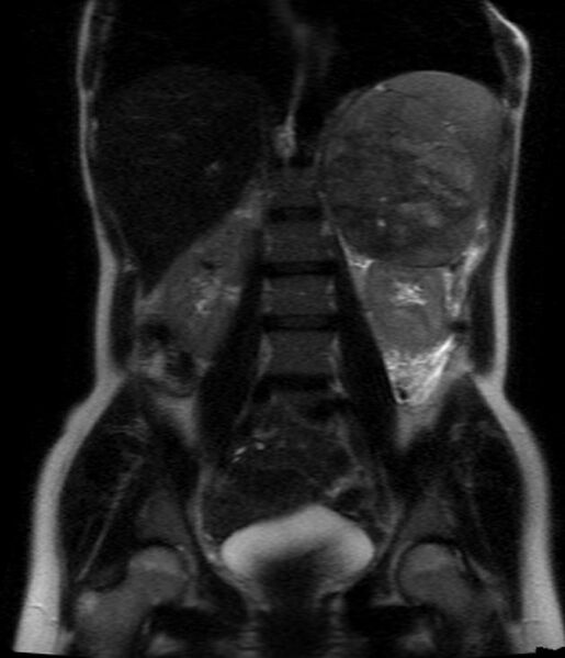 File:Adrenocortical carcinoma (Radiopaedia 11176-11541 Coronal 1).jpg