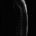 Aggressive vertebral hemangioma (Radiopaedia 39937-42404 Sagittal T2 12).png
