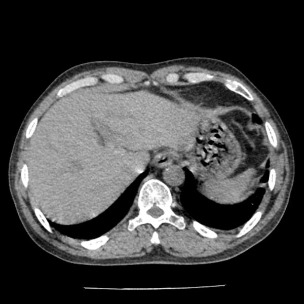File:Airway foreign body in adult (Radiopaedia 85907-101779 Axial liver window 176).jpg