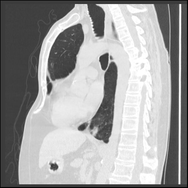 File:Alpha-1-antitrypsin deficiency (Radiopaedia 40993-43722 Sagittal lung window 130).jpg