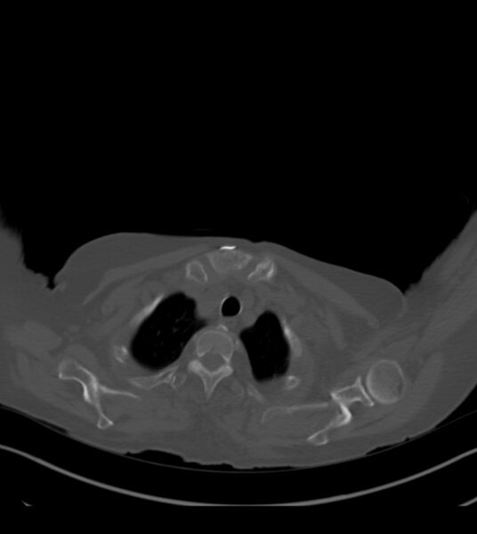 File:Amiodarone deposition in the liver (Radiopaedia 77587-89780 Axial bone window 11).jpg