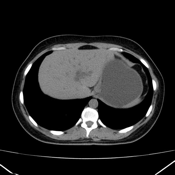 File:Ampullary tumor (Radiopaedia 22787-22816 Axial non-contrast 8).jpg