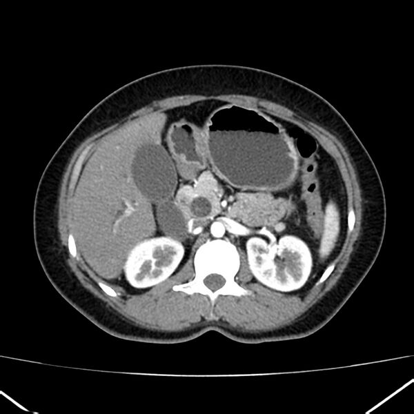 File:Ampullary tumor (Radiopaedia 22787-22816 B 33).jpg