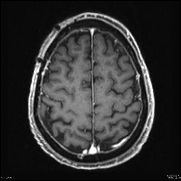 File:Anaplastic meningioma with recurrence (Radiopaedia 34452-35788 Axial T1 C+ 117).jpg