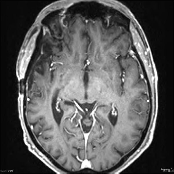 File:Anaplastic meningioma with recurrence (Radiopaedia 34452-35788 Axial T1 C+ 65).jpg