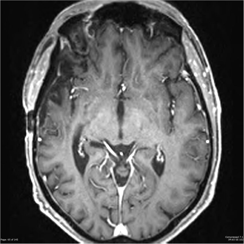 Anaplastic meningioma with recurrence (Radiopaedia 34452-35788 Axial T1 C+ 65).jpg