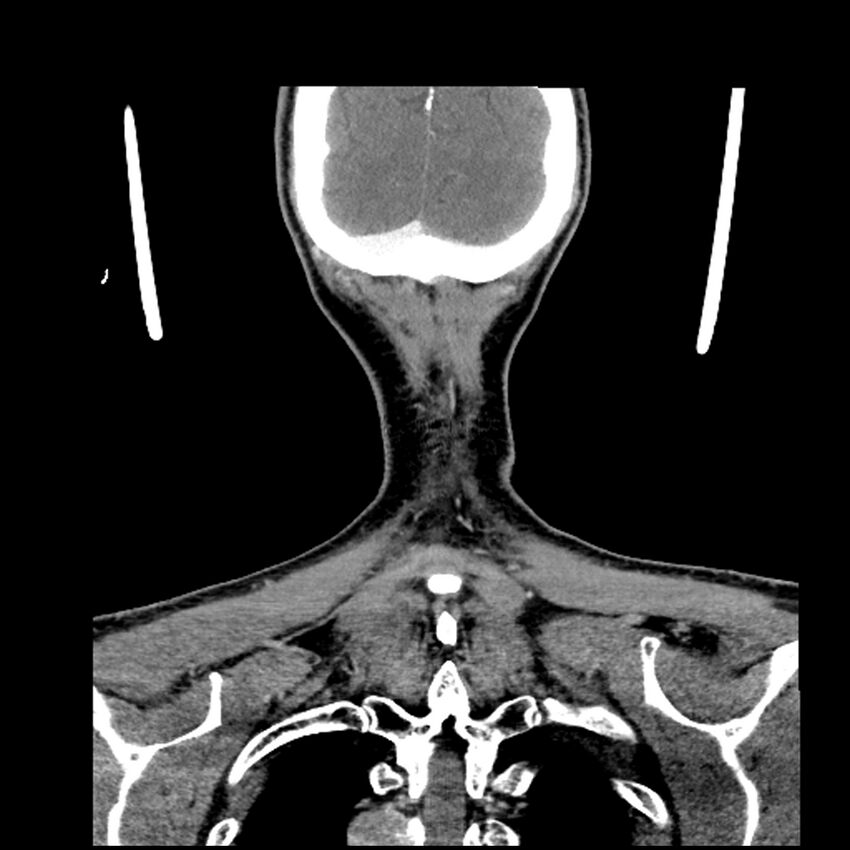 Anaplastic thyroid carcinoma (Radiopaedia 79087-92034 A 105).jpg