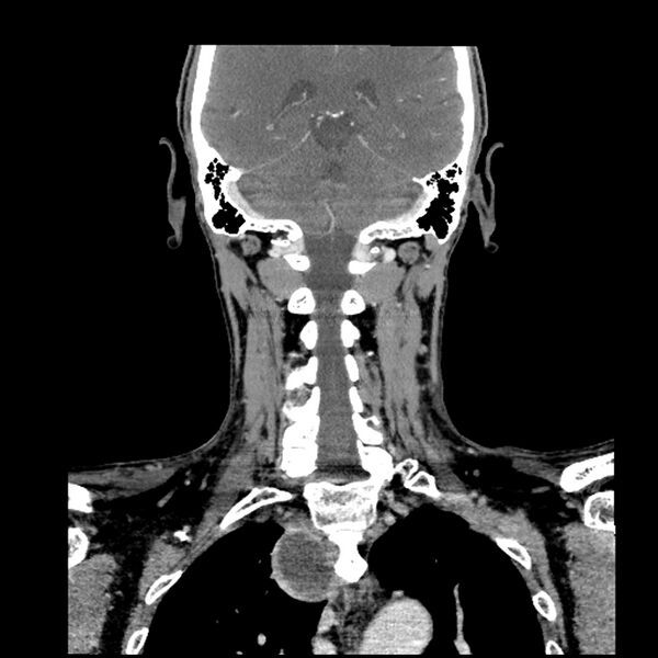 File:Anaplastic thyroid carcinoma (Radiopaedia 79087-92034 A 83).jpg