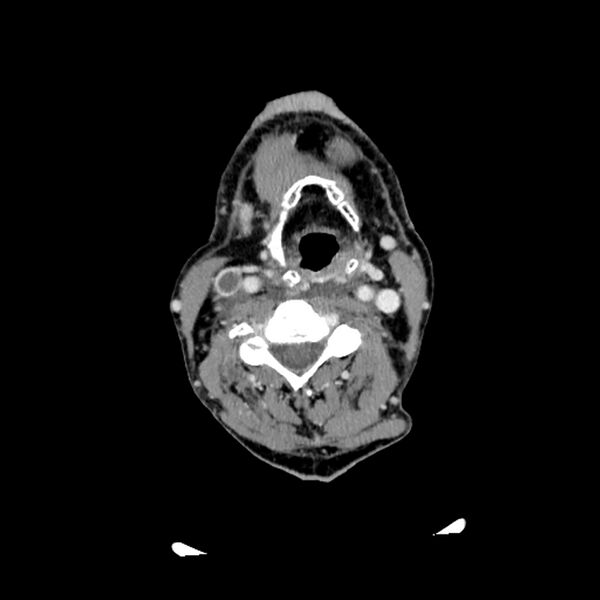 File:Anaplastic thyroid carcinoma (Radiopaedia 79087-92034 B 70).jpg