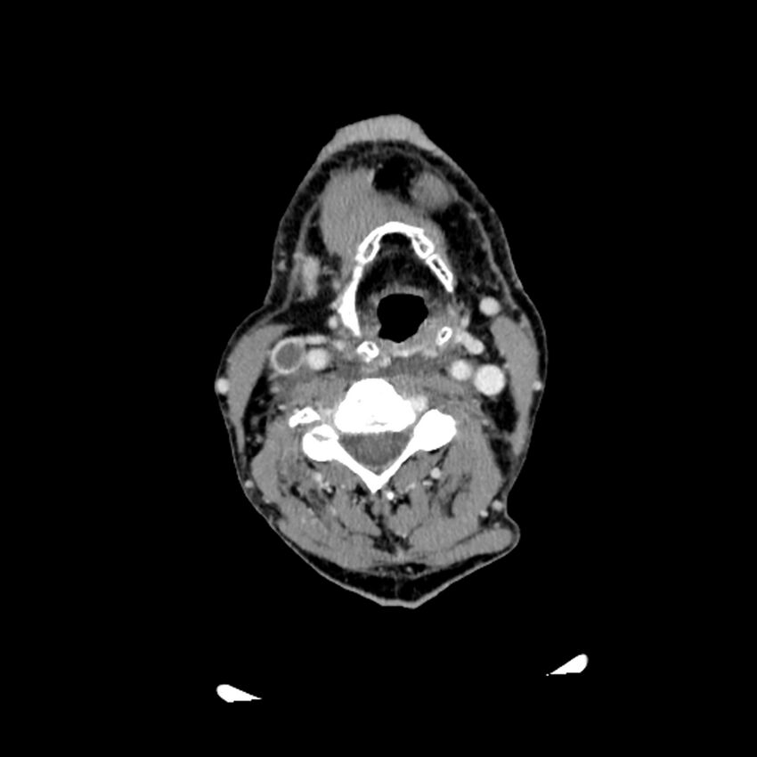Anaplastic thyroid carcinoma (Radiopaedia 79087-92034 B 70).jpg