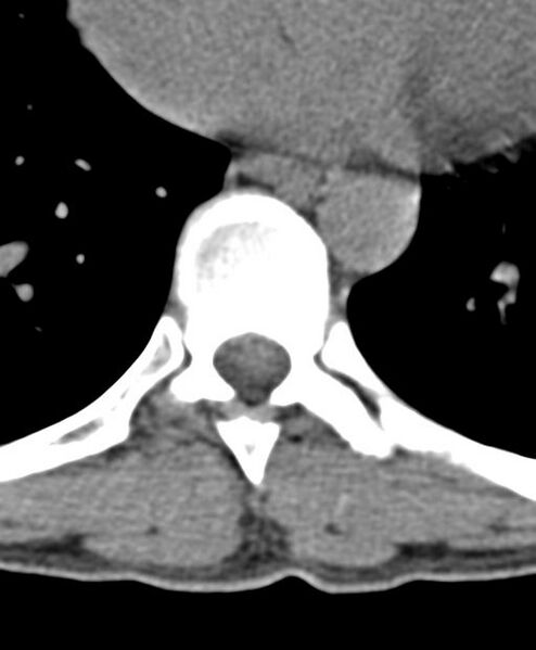 File:Aneurysmal bone cyst T11 (Radiopaedia 29294-29721 Axial non-contrast 20).jpg