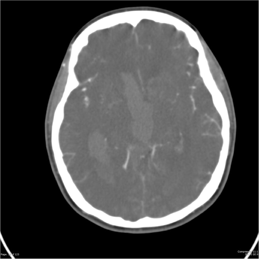 Aneurysmal subarachnoid hemorrhage and Moya Moya disease (Radiopaedia 34306-35593 Axial CT COW 30).jpg