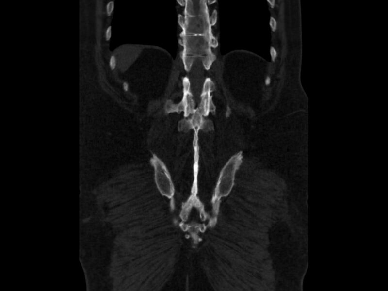 File:Ankylosing spondylitis (Radiopaedia 44609-48357 Coronal bone window 86).jpg